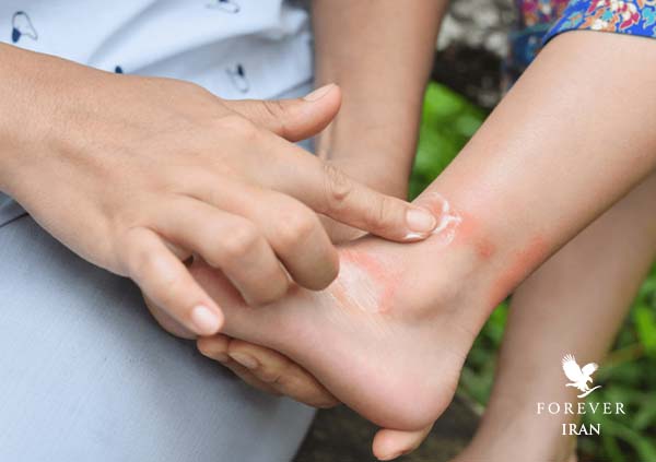 کرم مناسب آلرژی پوستی